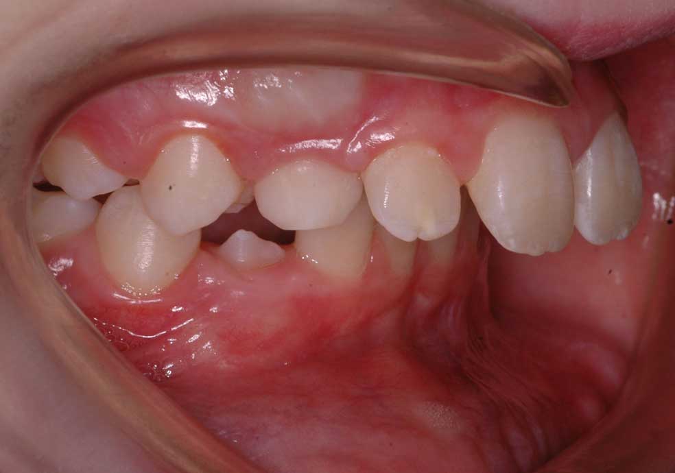 Upper Teeth Protrusion